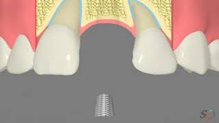 Implant Restoration Option 2 - Implants Guru