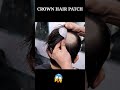 Crown hair patch for men in India