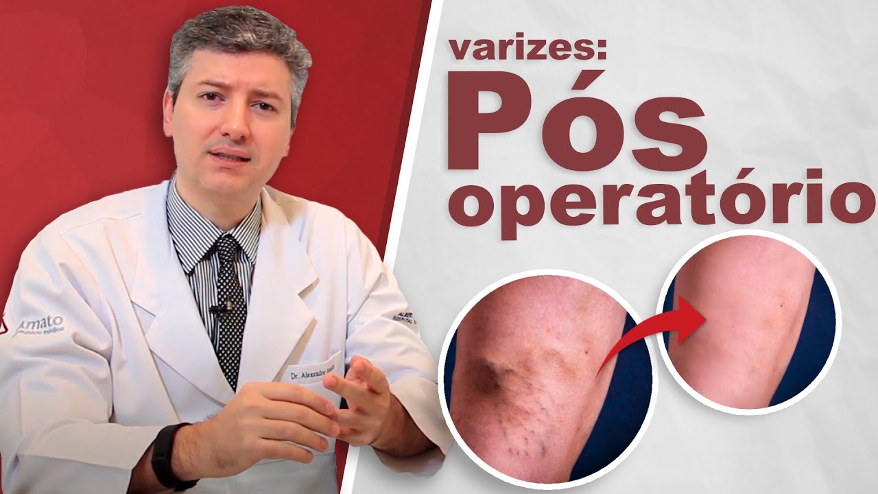 Como é O Pós Operatório Da Cirurgia De Varizes? (laser E Tradicional ...