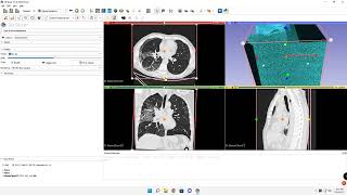 Lung volume rendering in 3D Slicer
