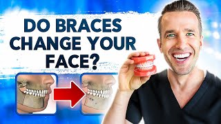 How Braces Change Your Face | Dr. Nate Orthodontist