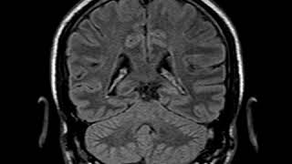 CNS C2 MRI Subacute Thrombosis