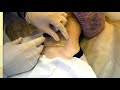 Vitiligo – new treatment approach - Video abstract [ID 229175]