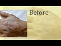 Vitiligo – new treatment approach - Video abstract [ID 229175]