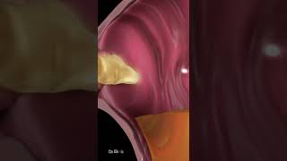 What Is Acid Reflux (Animation)