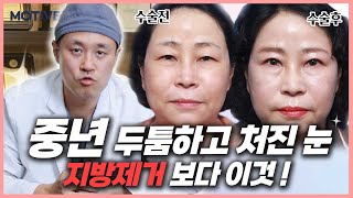 중년 두툼하고 처진 눈두덩이, 눈 지방제거보다 중요한 이것!? #중년눈성형