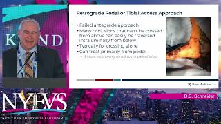 Crossing Techniques for BTK CTO  Trans Collateral, Subintimal, Direct Tibial Access, Retrograde Tech