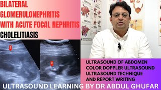 Ultrasound of kidneys | Glomerulonephritis | Nephritis | abdominal ultrasound | cholelithiasis | usg