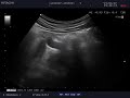 Case 118 : Normal renal arteries in ultrasound