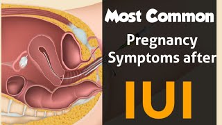 Most common Pregnancy symptoms after IUI English