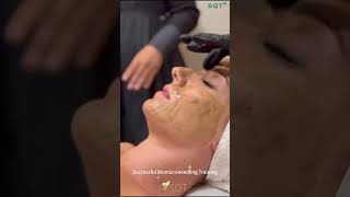 This is the #biomicroneedling training in Valencia.