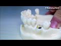 Part 3 Immediate Dental Implant Placement Technique - Indonesian Dental Training Center