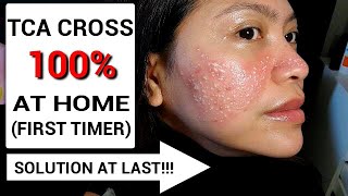 DIY 100% TCA Cross at Home/Acne Scar Treatment/Demonstration/First Try DIY/BelleLife Tv