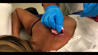 HUGE HARD CYST ON WOMANS BACK BURSTS 💥