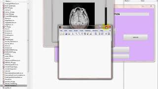 Matlab code for Detection of brain tumor from MRI images by using segmentation & SVM