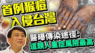 首例猴痘入侵台灣！　醫曝傳染途徑：這類人重症風險最高｜中時新聞網