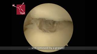 Arthroscopic Treatment of Osteochondral Talar Defects