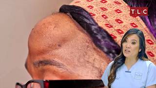 Shoshana's Forehead Secret! | Dr Pimple Popper S3 E5 | TLC India