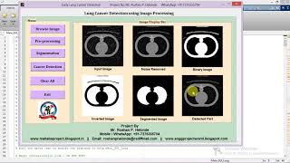 Matlab code for Lung Cancer Detection Using Image Processing