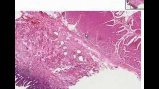 Histopathology Esophagus  --Barrett esophagus