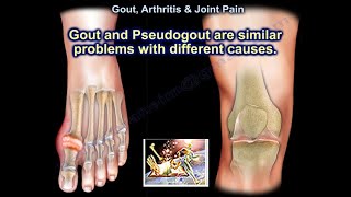 Gout , Pseudogout  & Joint Pain - Everything You Need To Know - Dr. Nabil Ebraheim