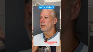 Deep Neck Facelift 1 Week (Interview)