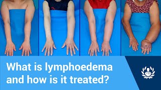 What is lymphoedema and how is it treated