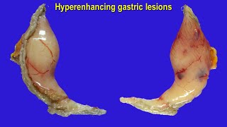 Hypervascular lesions of stomach - glomus tumor, GIST, NET, ectopic pancreas ...