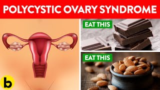 Eat These Foods If You Want To Manage Polycystic Ovary Syndrome | PCOS Diet