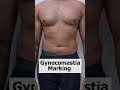 gynecomastia surgery planning gynecomastia treatment shorts