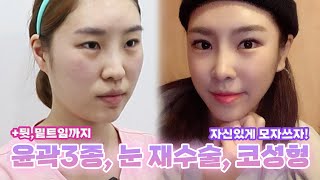 [윤곽 3종+쌍수 절개 재수술+코성형] 광대, 사각턱, 안면비대칭... 있었는데요? 없습니다;; 얼굴에 굴곡이 사라지는 마법✨ +뒷밑트임으로 시원시원한 이목구비는 뽀나쓰♥ [쀼]