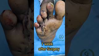 கால் விரல்களில் ஏற்படும் எலும்பு முறிவு|Foot crush injury surgery|Toe surgery|Foot fracture surgery