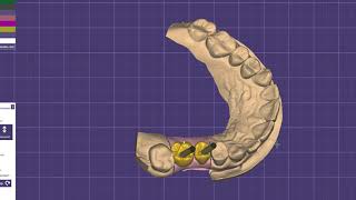 EXOCAD моделировка коронок на винтовой фиксации