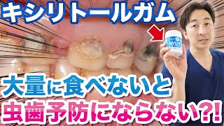 キシリトールガムで虫歯予防って本当にできるの？【虫歯】#shorts