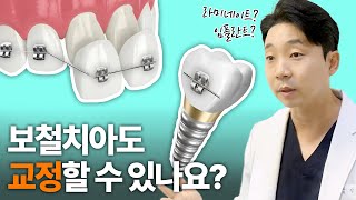 라미네이트, 임플란트 했는데 교정 가능할까요? | 보철물 교정