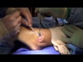 ankle ligament repair surgery video using an internal brace