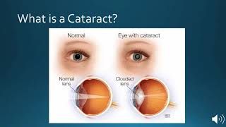 Understanding Cataract Surgery and Lens Options at Bochner Eye in Toronto