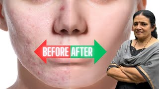 Say Goodbye to Pimples | മുഖക്കുരു എങ്ങനെ നീക്കം ചെയ്യാം