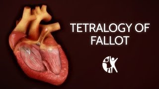 Tetralogy of Fallot | Cincinnati Children's