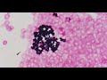 今日のグラム染色この一枚 staphylococcus aureus 黄色ブドウ球菌による菌血症