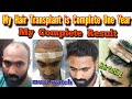 Hair Transplant || One Year Hair Transplant Journey ||