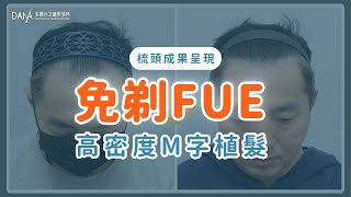 【梳頭成果呈現】免剃FUE | 高密度M字植髮篇