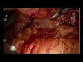 robotic pancreaticoduodenectomy robotic whipple procedure