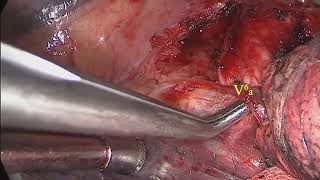 Asvide: The right S¹a + S² + S⁶a segmentectomy for deep interlobar lung cancer with fused fissure.