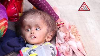 टाउकोमा पानी जमेपछि यस्तो भयो बच्चाको अवस्था, सहयोगको लागी अपिल || Help for baby