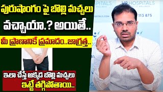 పురుషాంగంపై బొల్లి మచ్చలు వస్తే ప్రమాదమా : How to Cure Vitiligo Permanently By Dr Srikanth Munna