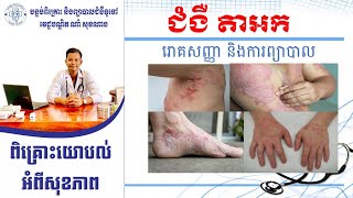 ជំងឺតាអក Eczema Dr. Nam Soknang