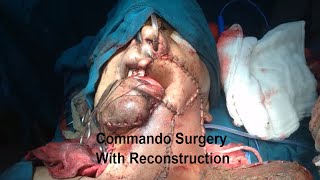 Commando surgery with reconstruction by Dr  Majid Ahmad Talikoti