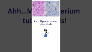 Granulomas in bone marrow biopsies https://jcp.bmj.com/content/77/1/8