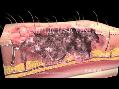 What does an acid burn look like?